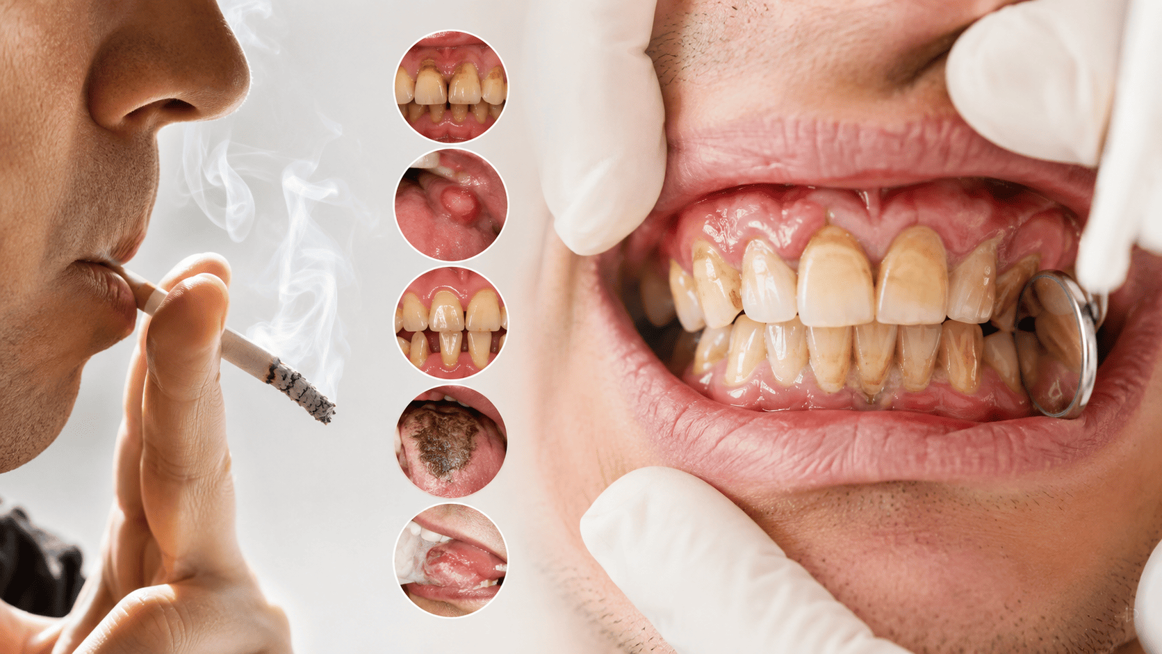 Effects of Smoking on Oral Health & Dental Treatment in Thane