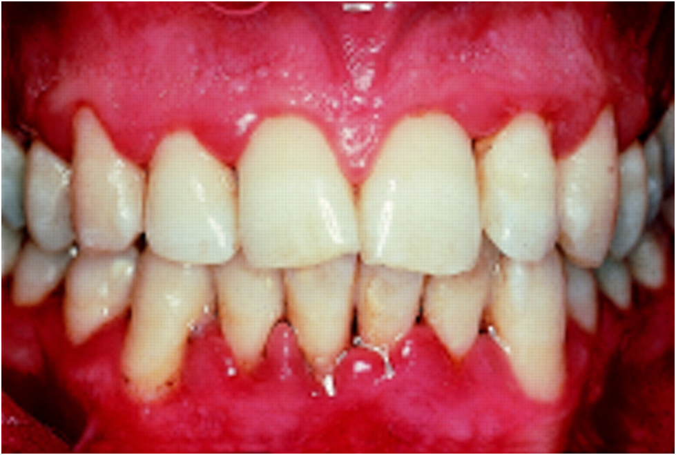 Lichen Planus: Diagnosis and Treatment in Thane