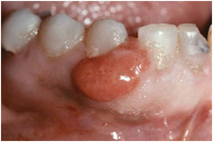 Acute Necrotizing Gingivitis Solution in Thane