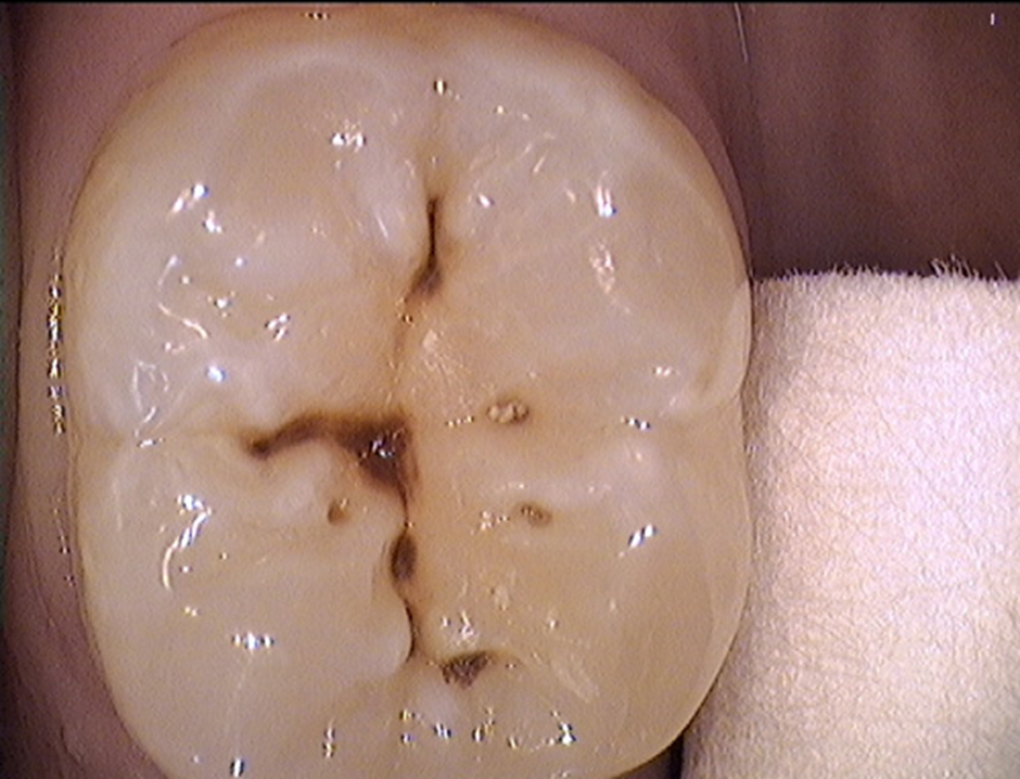 Pit and fissure sealant procedure for preventing tooth decay
