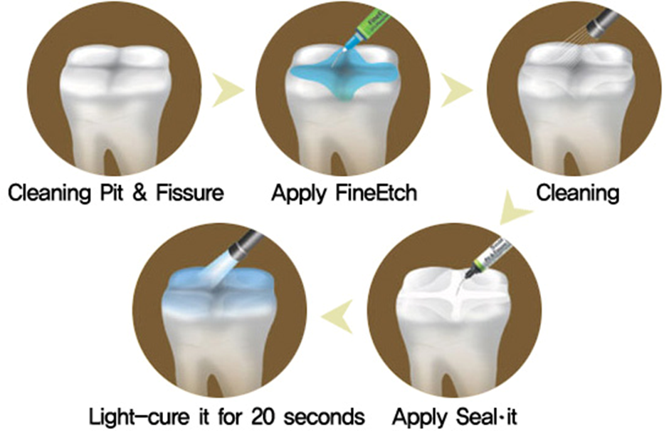Pit and Fissure Sealants in Thane: Procedure, Benefits and Prevention of Tooth Decay