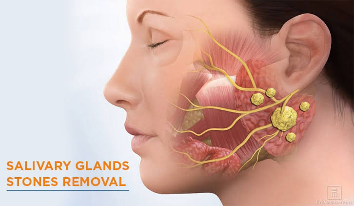 Clinical presentation and removed salivary gland stone