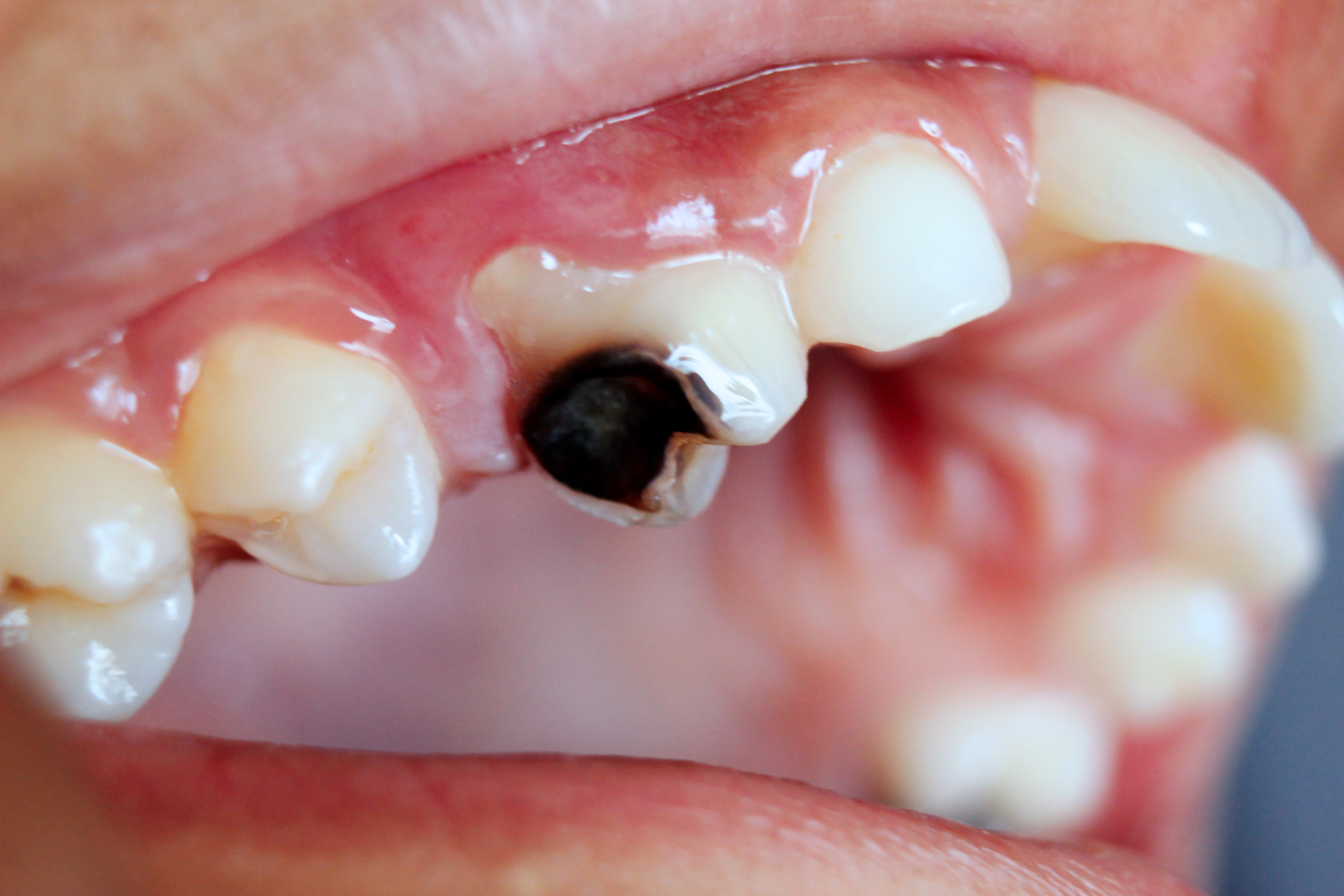 Bacteria and acid attack on teeth